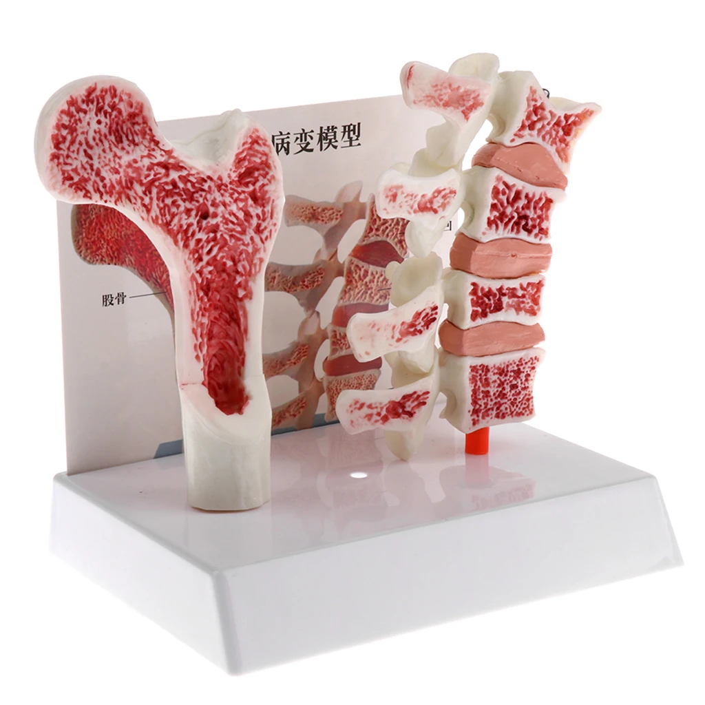 1:1 Anatoomilise Inimeste nimmelüli kohalt Thighbone Mudel, Osteoporoosi Skelett Mudel, Teaduse Klassiruumis Uuringu Ekraan
